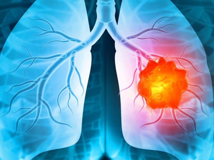 الجمعية المغربية للطب الصدري التدخلي تنظم مؤتمرها الدولي الثاني لطب الرئة بمراكش