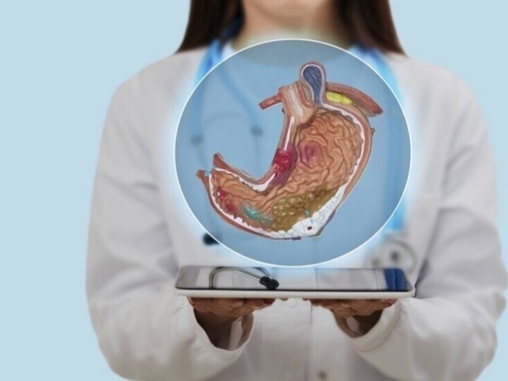 قرحة المعدة..كيف يمكن التخفيف من أعراضها في المنزل؟